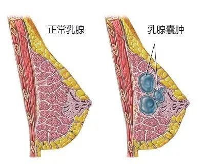 查出这些乳腺疾病别太着急大部分是良性的