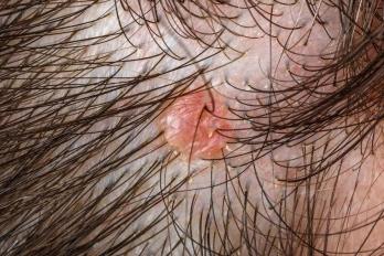 头皮纤维瘤图片