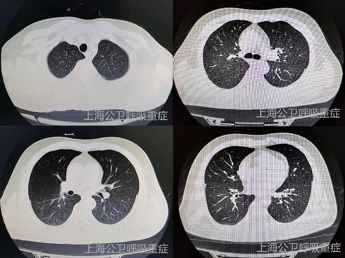 1例"特殊"的吸入性肺炎