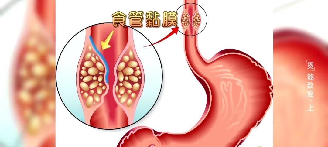 食管是唯一跨越頸部,胸部,腹部的器官,長42釐米,它有三個生理狹窄部位