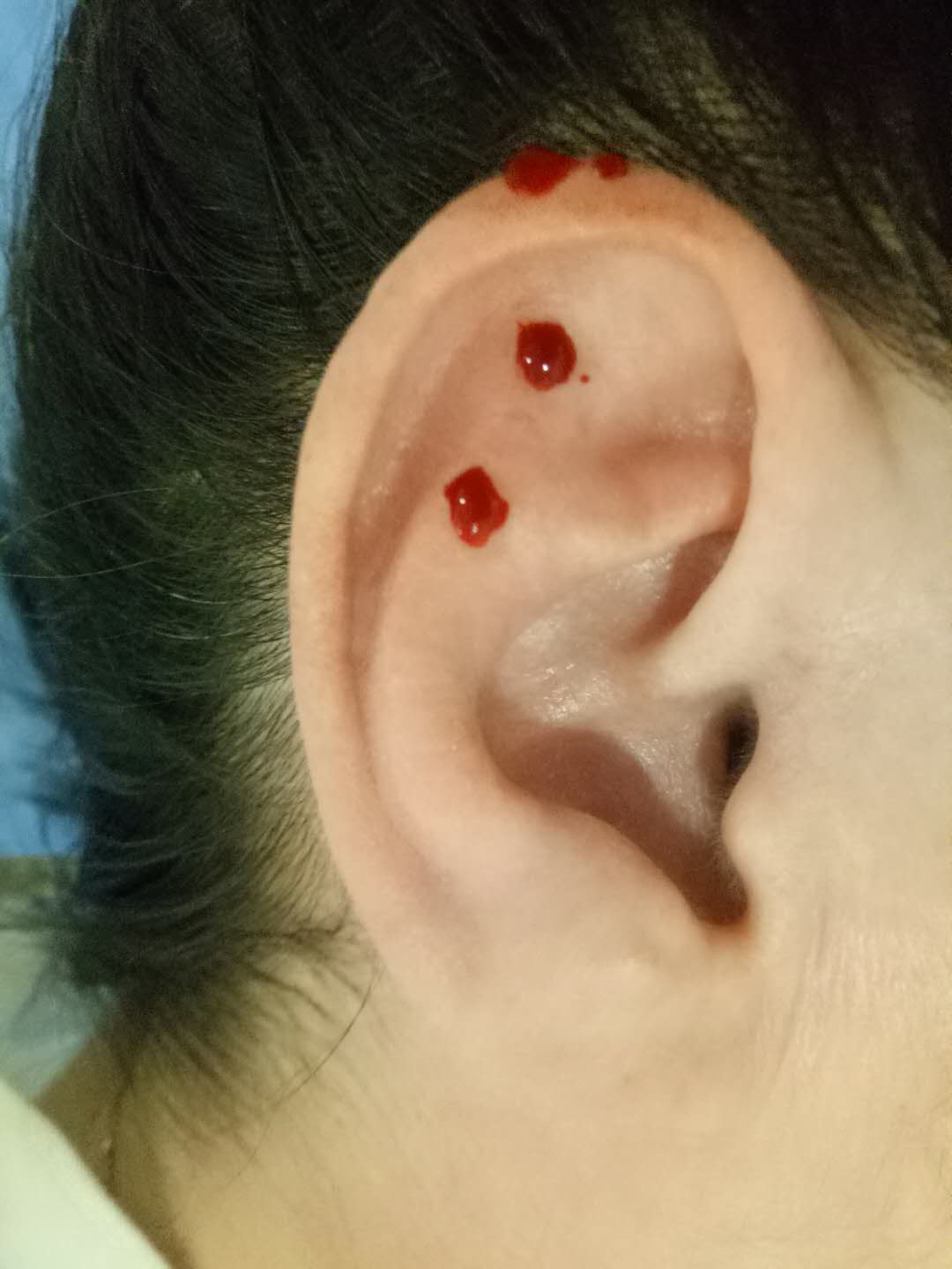 耳背静脉放血疗法图片图片