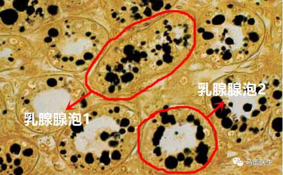 如上图所示,乳腺腺泡1的腺泡中含的乳汁不多,所以脂肪细胞(被染成黑色