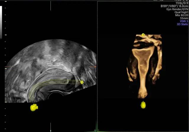 科普备孕好帮手四维输卵管造影