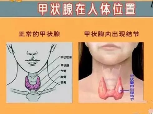 颈部甲状腺区域分布图图片