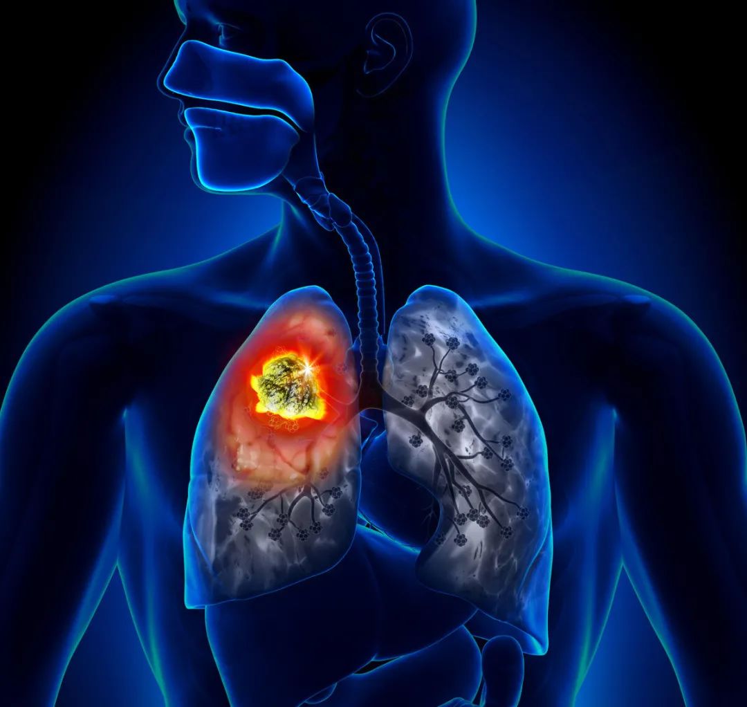 第二节 不同组织类型肺癌的CT表现-呼吸系统-医学