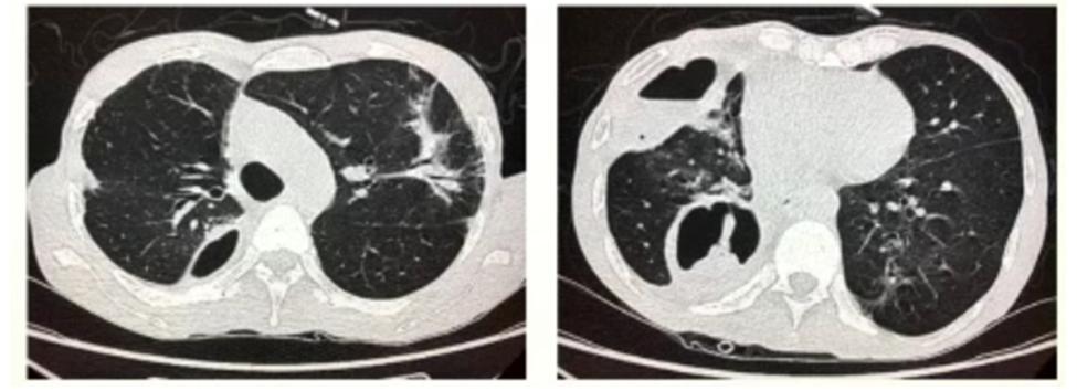 肺部气液平面图片