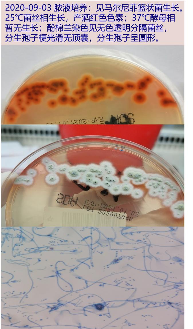 09-03 脓液(08-26送检)真菌培养回报:sda培养基25℃见菌落生长,菌落最