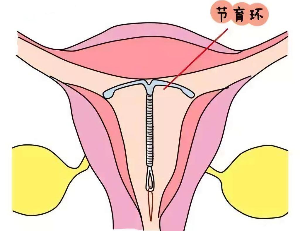 避孕环位置图片