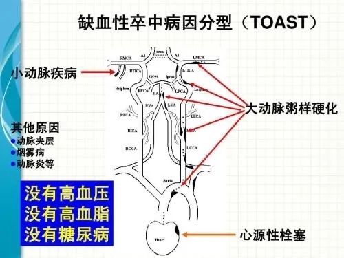 脑梗死病因图片