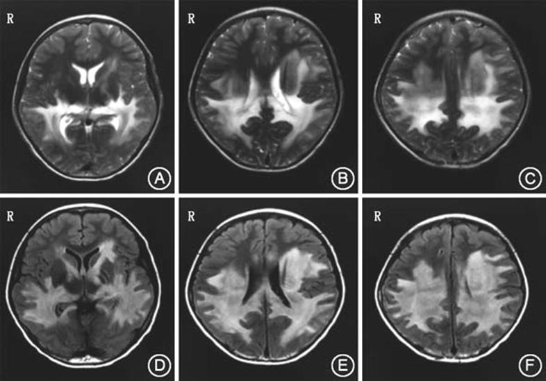 而影像上表現為白質異常信號時(尤以半卵圓後部和胼胝體壓部明顯時)