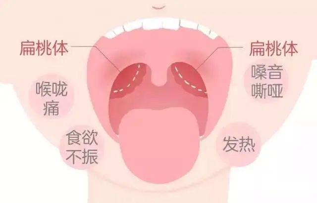 秋季天气干燥容易上火 缓解咽喉不适的自然疗法 试一下这些办法来镇痛