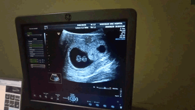 【小南话科普】做阴超会流产?阴超其实没那么可怕!