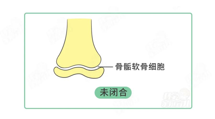 在宝宝成长过程中,骨骺软骨细胞会不断分裂,增殖,骨化,使骨加长.