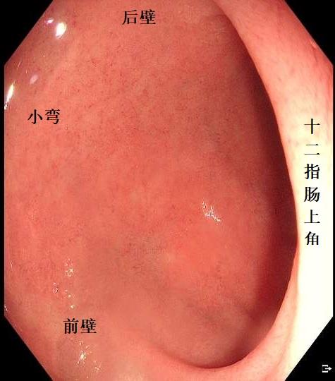 胃十二指肠球部图片