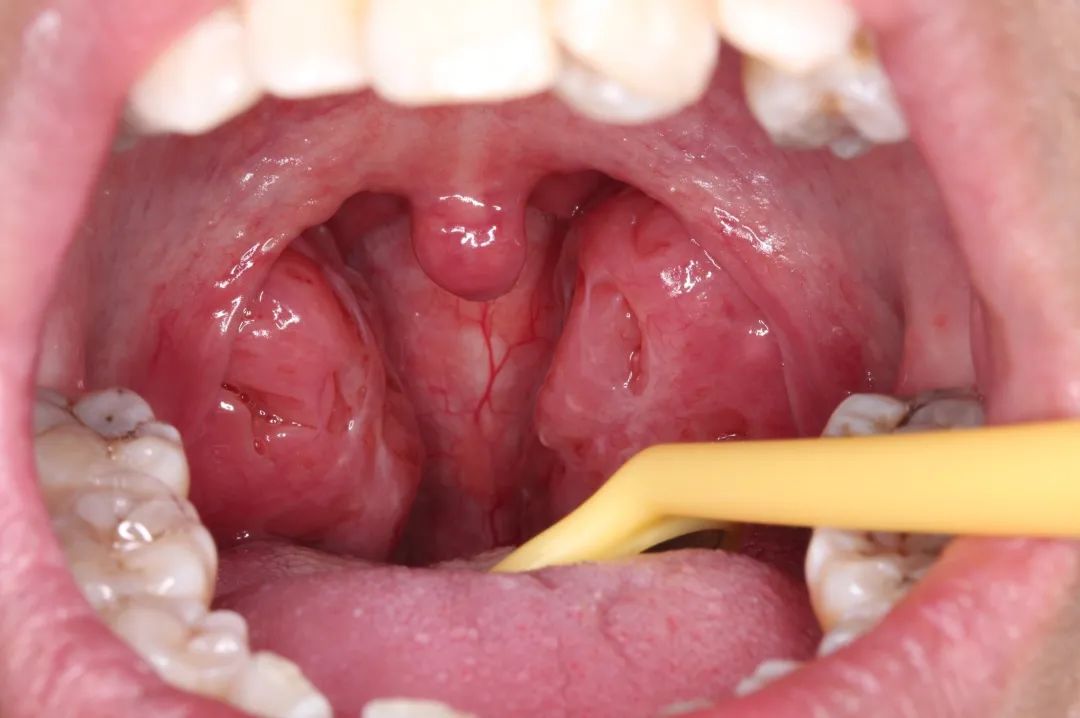 正常的腺样体与肥大的腺样体扁桃体位于口咽,口咽大小受下颌位置的