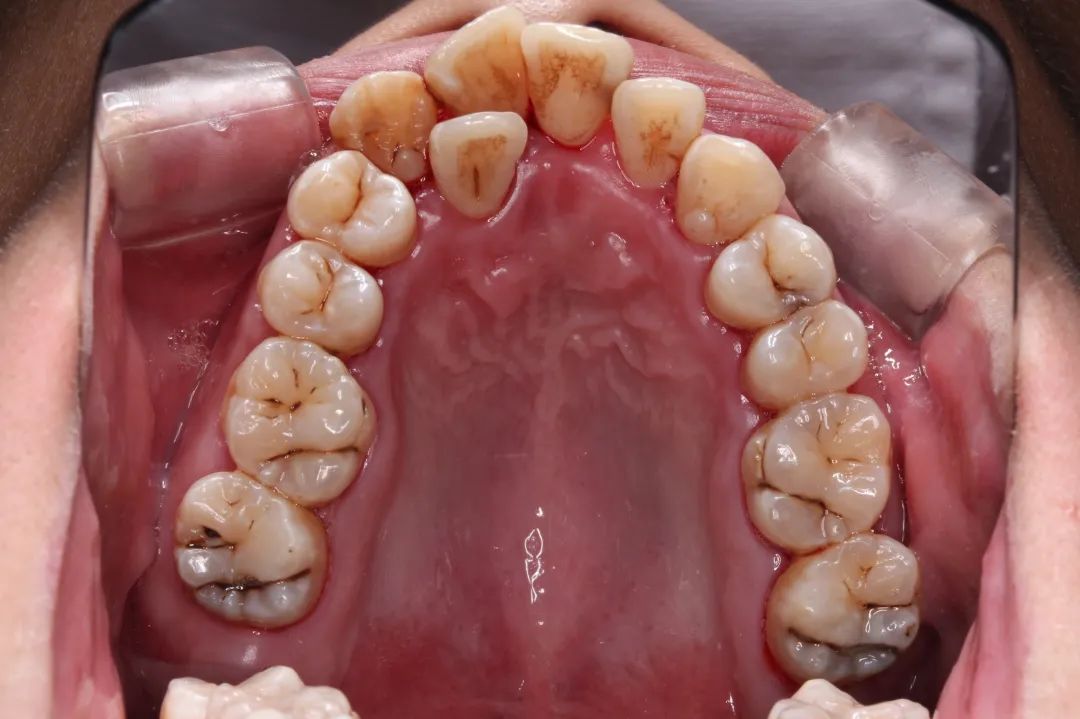 长期口呼吸引起的上牙弓狭窄,前牙严重拥挤长期口呼吸引起的上前牙前