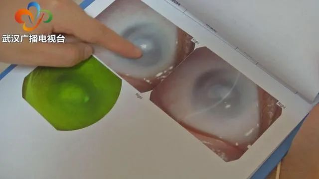 10岁的妮妮终于能看见了