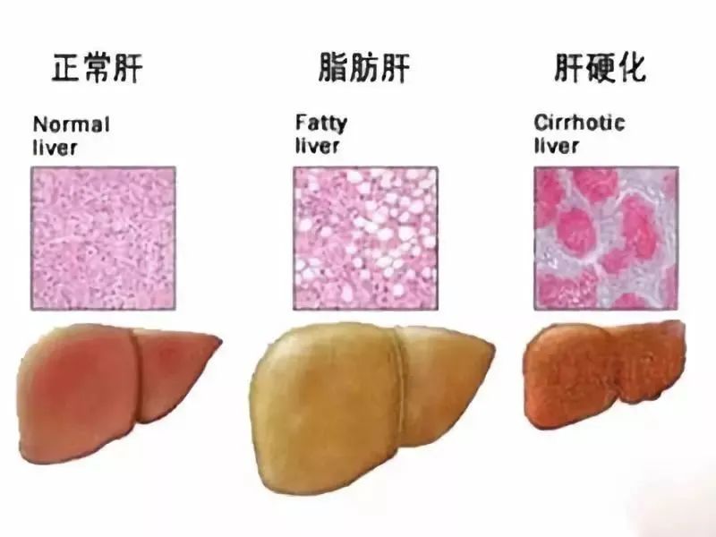 轻度脂肪肝 不可忽略的隐形炸弹 湃客 澎湃新闻 The Paper