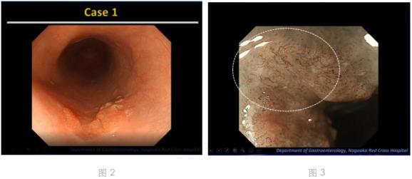 位於食管中斷的隆起性病變(圖2),在nbi放大下病變背景黏膜為b1型改變