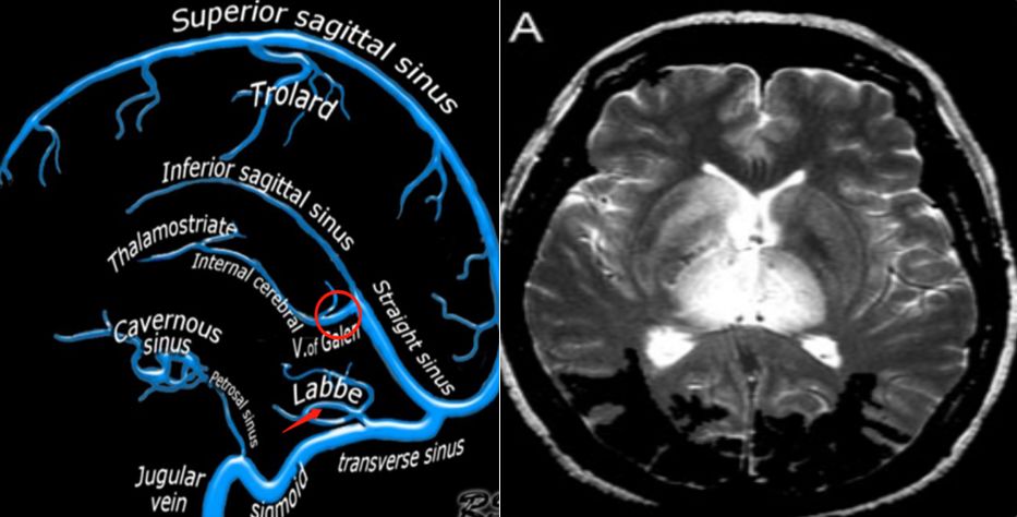 (左图来源于北美放射学教学网站文献7,红圈标识处提示galen静脉,红