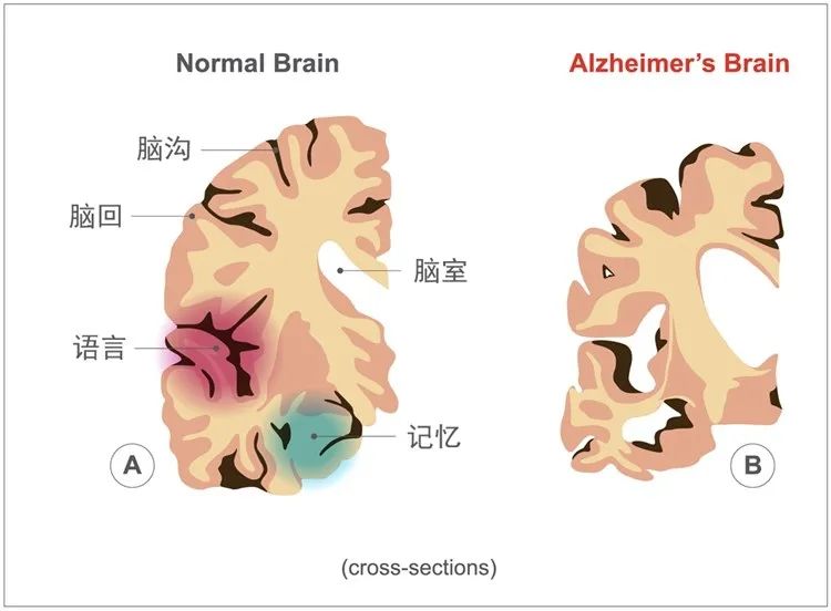 20岁阿尔茨海默症图片