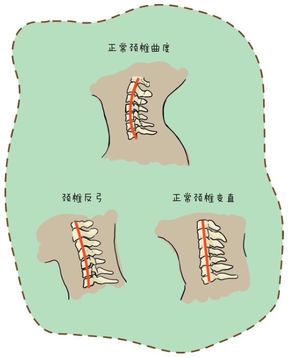 不正确的颈部姿势会引起颈椎的曲度变化—变直,甚至反弓