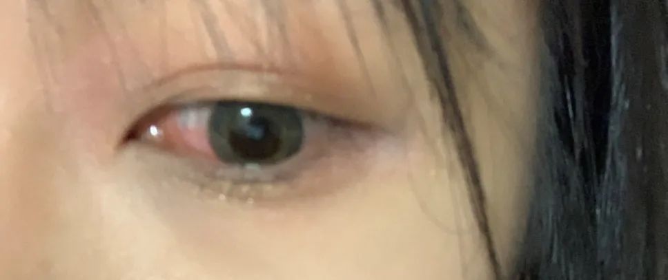 戴美瞳后眼睛上长了寄生虫