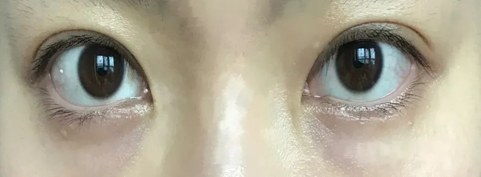 戴美瞳后眼睛上长了寄生虫