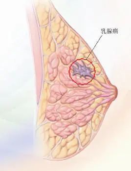 乳腺脂肪瘤图片大全图片