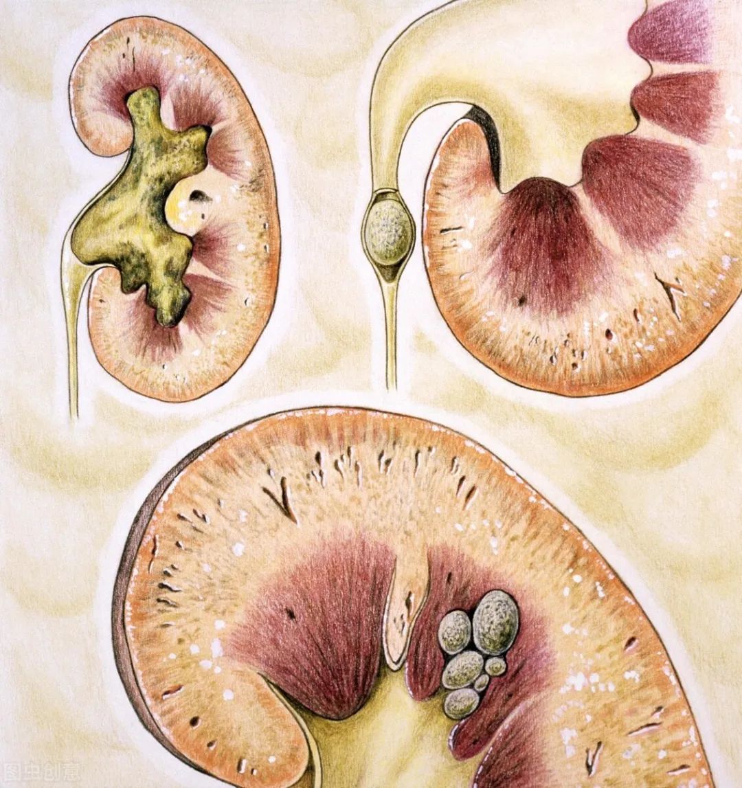 肾结石,肾积水怎么治疗 _肾积水怎么治疗-第2张图片-潮百科