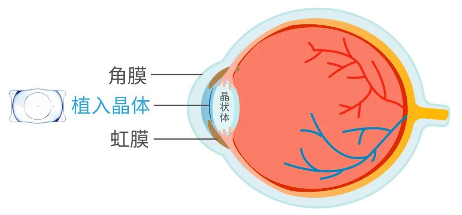 近视手术能不能做 怎么做 湃客 澎湃新闻 The Paper