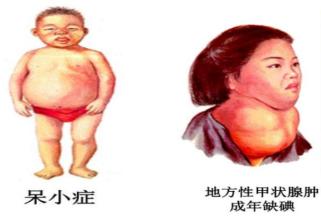 呆小症婴儿图片