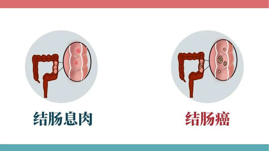 腸息肉和腸癌在症狀上有什麼區別