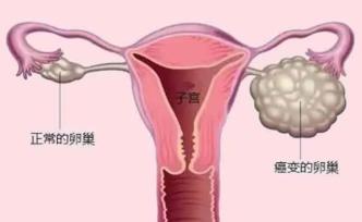 卵巢癌术后复发，铂类耐药不可怕：卵巢癌治疗进入靶向时代