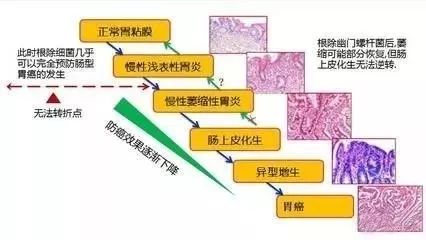 被诊断为慢性萎缩性胃炎离胃癌还有多远