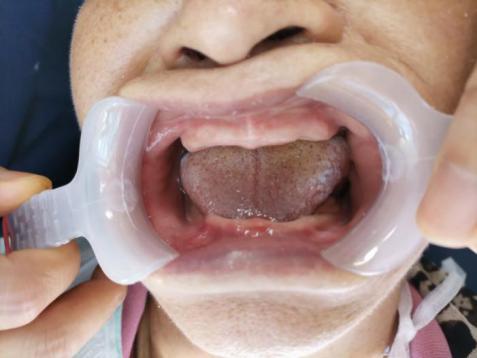 医疗技术还您口福无牙颌患者戳进来