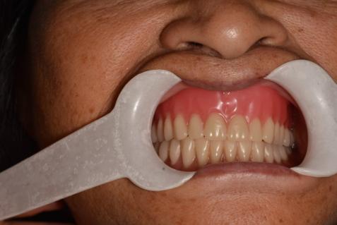 医疗技术还您口福无牙颌患者戳进来
