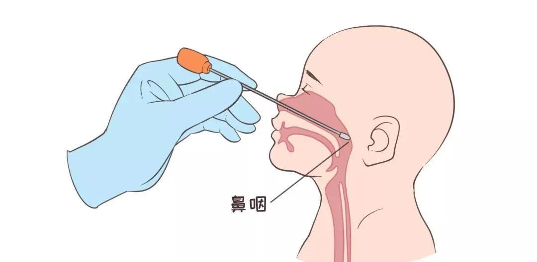 鼻咽拭子采集解剖图图片