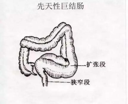 巨结肠伴发小肠结肠炎:严重时出现感染性休克甚至死亡2.