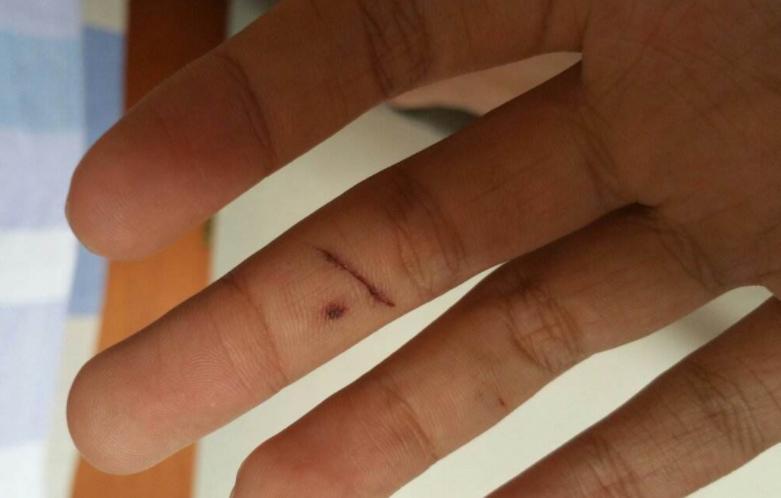 铅笔芯不小心扎进手里除了清创消毒还要打针