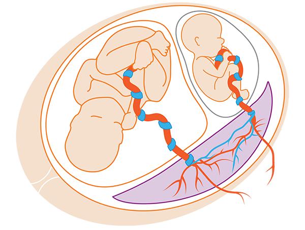 当试管婴儿遇上双胎输血综合征一场医院里的奇妙旅行