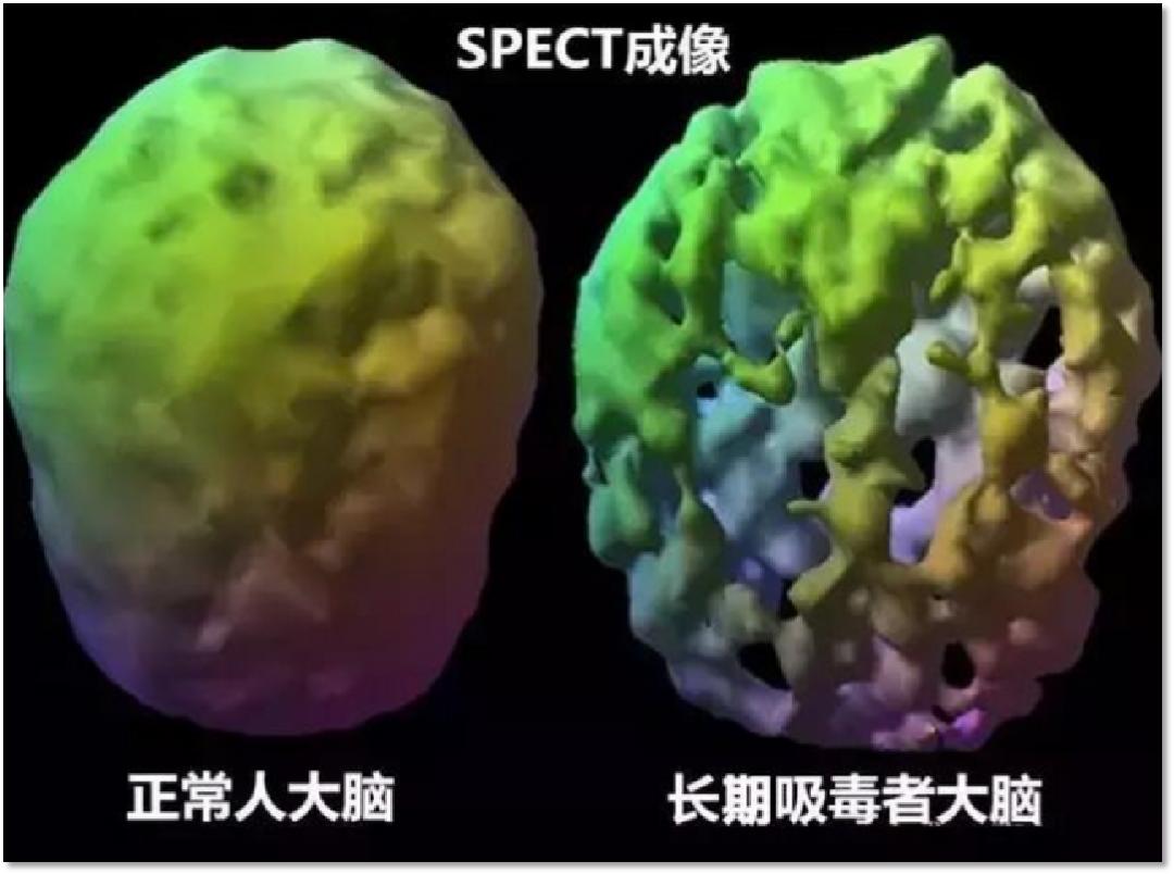 冰毒属于中枢兴奋药,它和摇头丸一样,有致幻效果,每吸食一次,大脑就会