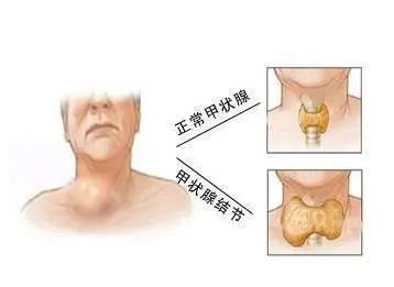 喉结的位置图片
