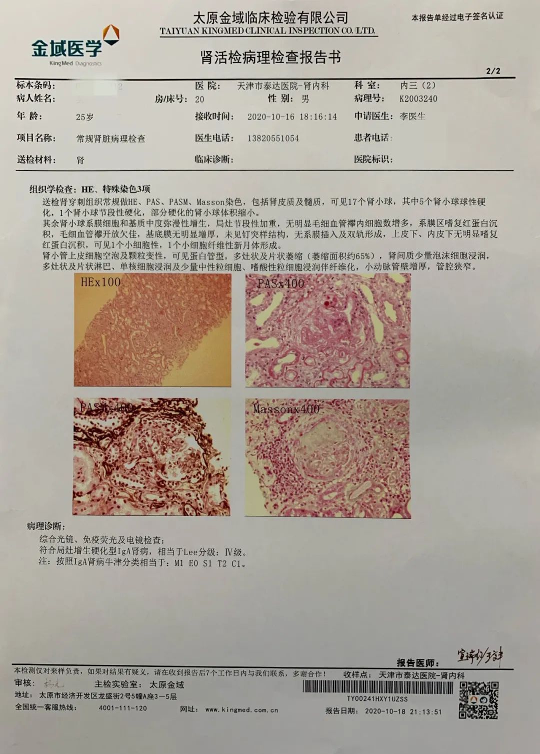 结果为:局灶增生硬化型iga肾病,应该说,病理比较重,而且还在活动,肯定
