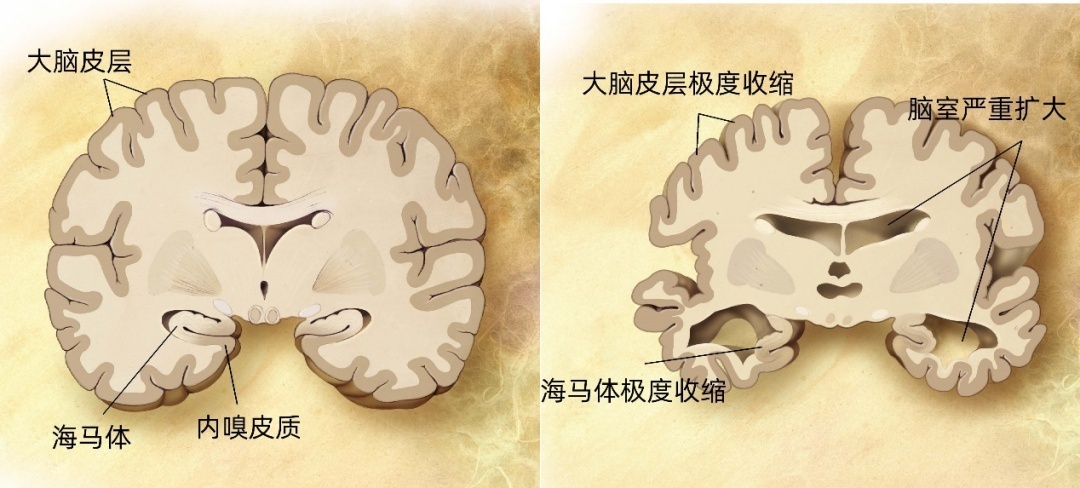 通过观察患病人群脑部图像发现