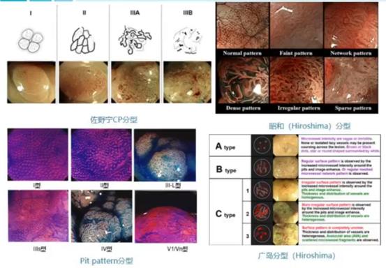 胃息肉山田分型图片图片