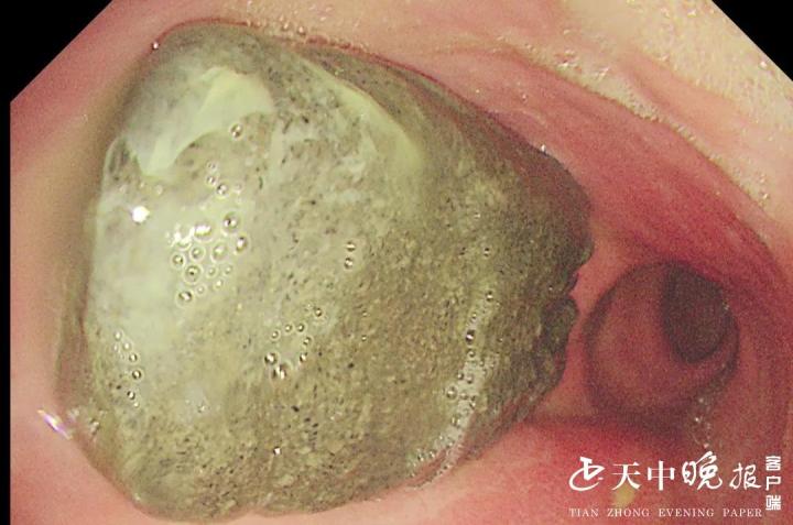 胃柿石碎石及取石术”。胃镜进入胃腔后，可见一黄色鸡蛋状大小的胃石。