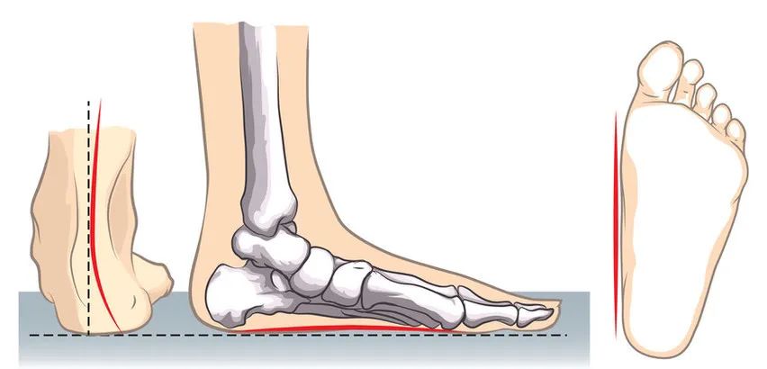 同济医生说俞光荣平足症是否需要手术治疗