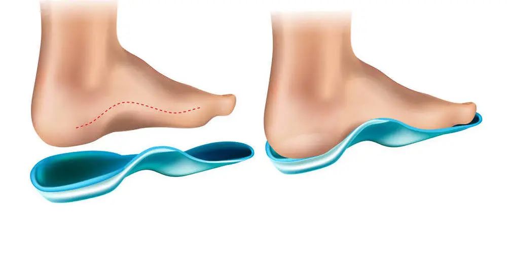 【同济医生说】俞光荣：平足症是否需要手术治疗？_澎湃号·政务_澎湃新闻The Paper