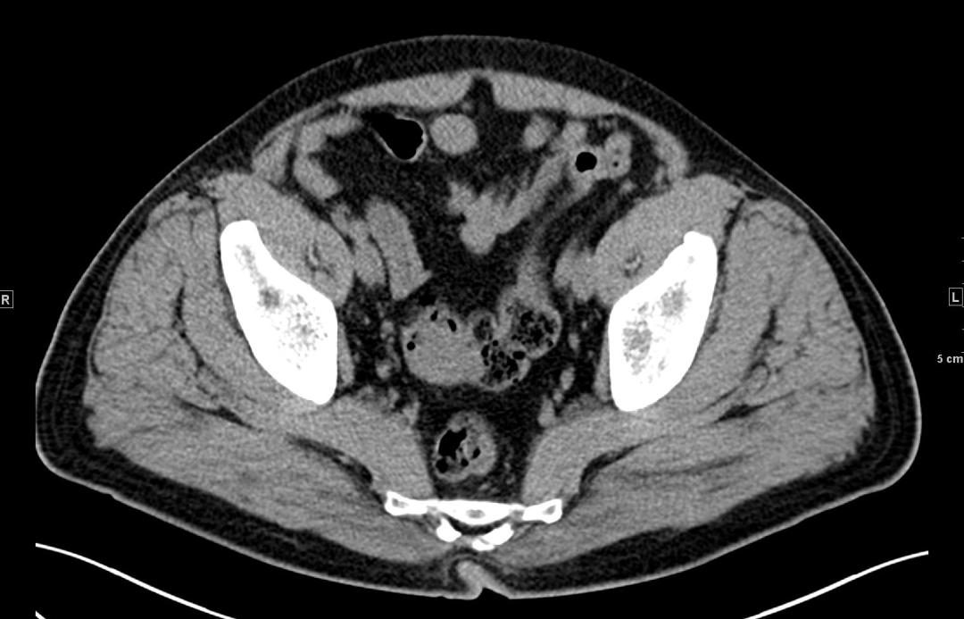 上图,大家仔细看,可以看到乙状结肠肠腔内软组织影